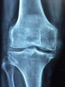 osteoporoza boli