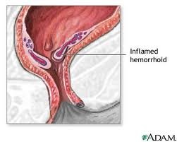 hemoroidy-palacy-problem