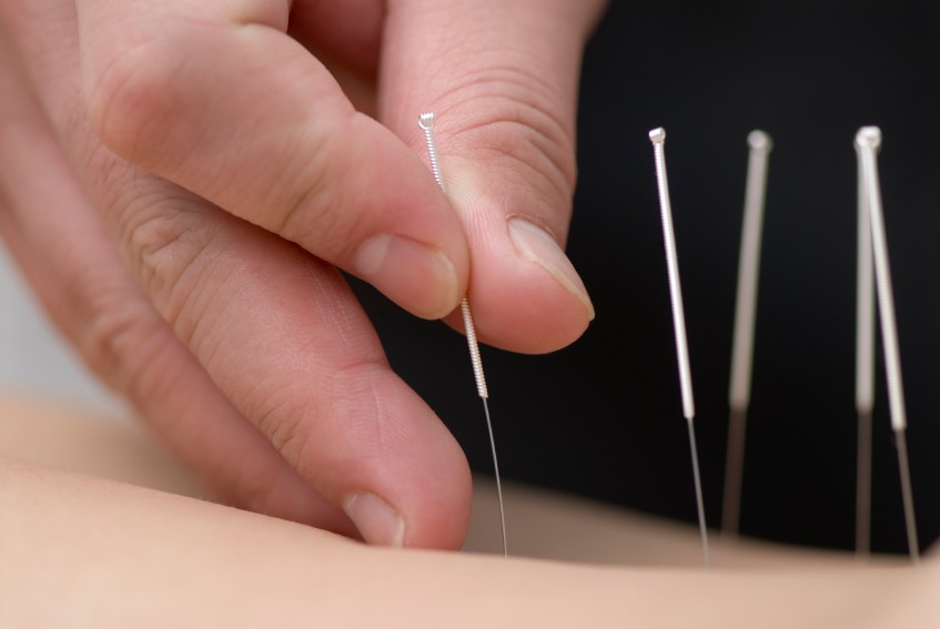 akupunktura-w-leczeniu-uderzen-goraca