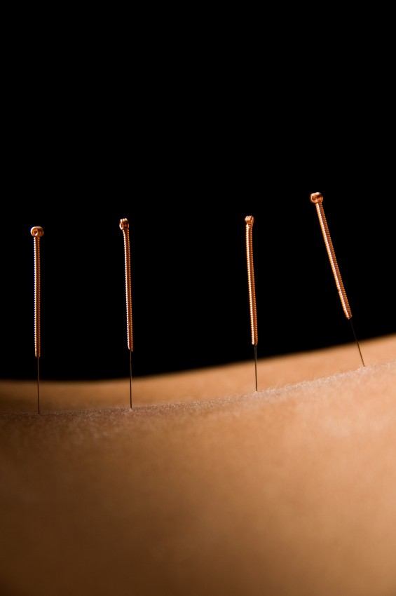 co-to-jest-akupunktura